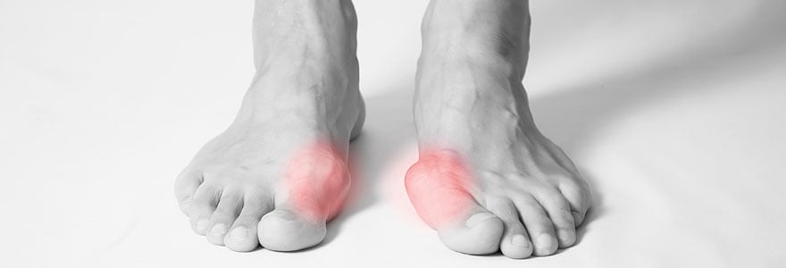 Hallux valgus